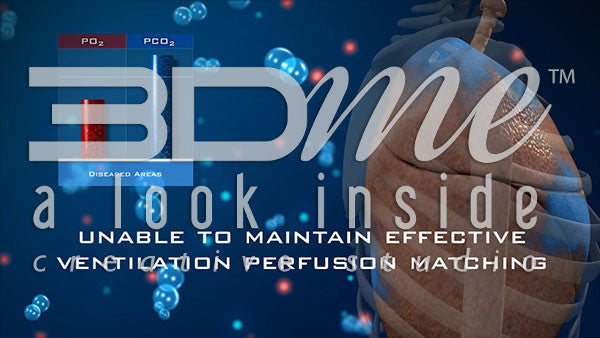 When lung disease progresses and local reflex mechanisms fail to compensate, what happens to PO2 and PCO2 levels in the blood?