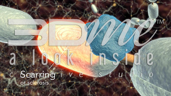 Where does MS get the name from?