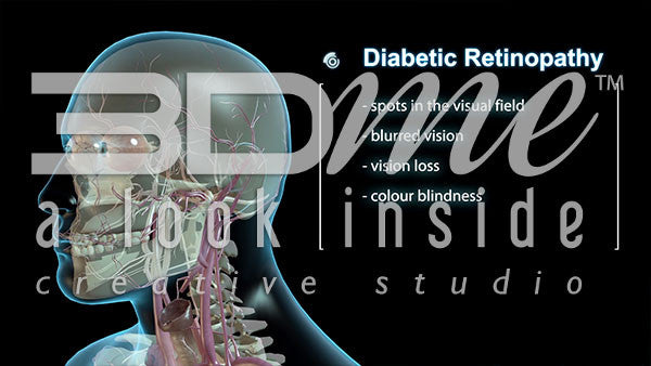 Graphic Listing - Diabetic Retinopathy