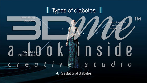 Gestational Diabetes