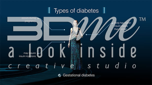 Graphic - Diabetes Types 4