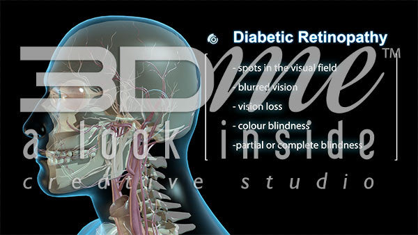 Head (Side View) Diabetic Retinopathy