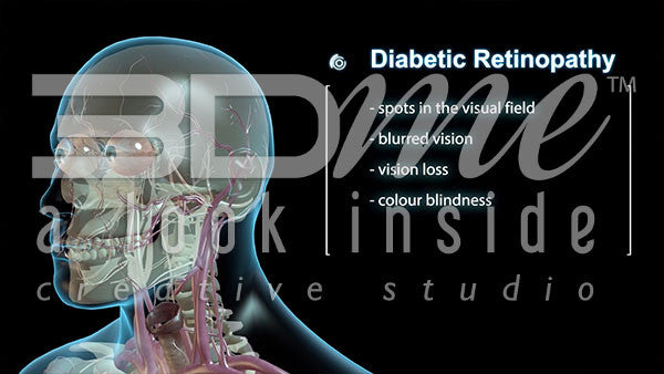 What is Diabetic Retinopathy?